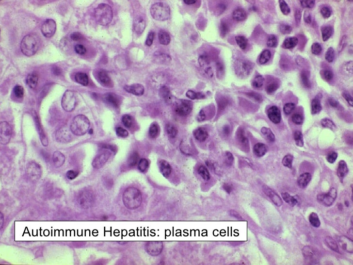ipertiroidismo autoimmune