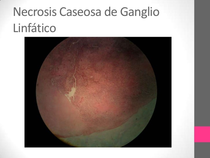 Que pinchazo hacen del alcoholismo