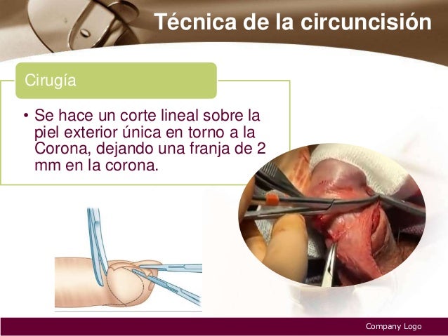 El aumento del pene a la medicina pública