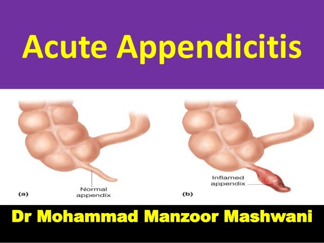 L Acute Appendicitis