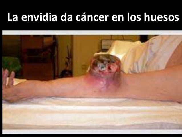 CANCER A LOS HUESOS cancer a los huesos: