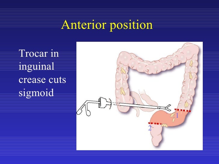 Laparoscopic Sigmoid Colon Resection for Diverticular Disease