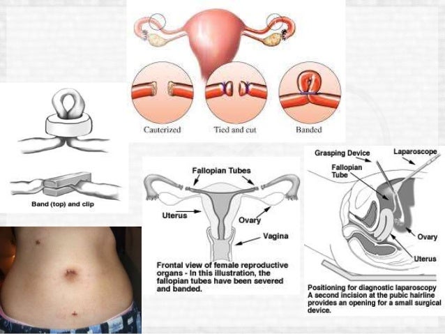 2019 year - What Is Tubal Ligation 2019 year