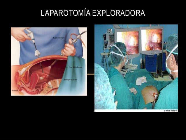 Laparotomia exploradora