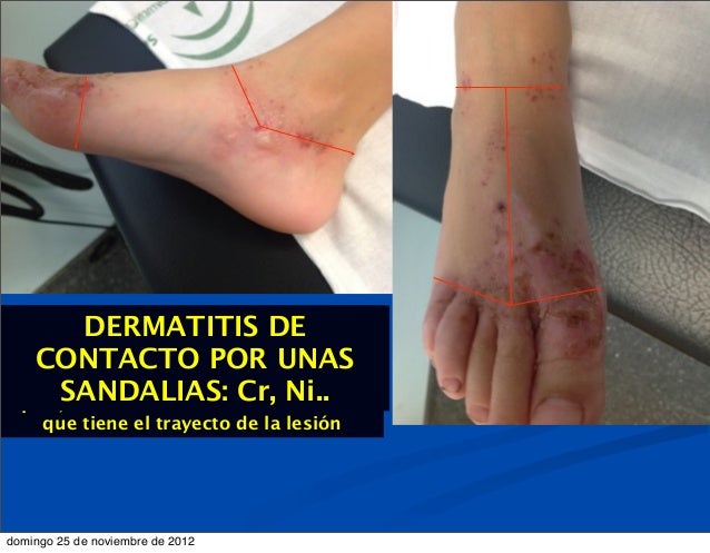 Como curar neyrodermit en las manos