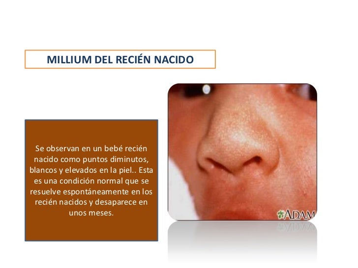 Batel la crema de las pecas
