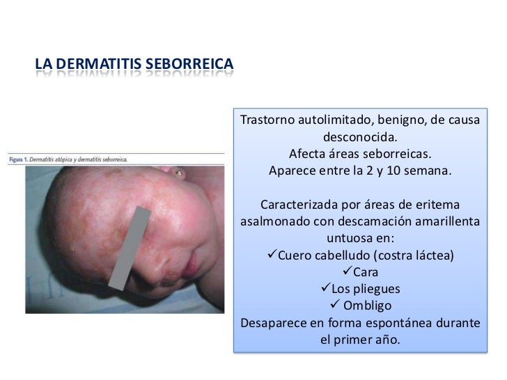 Quiero al niño y al marido la psoriasis