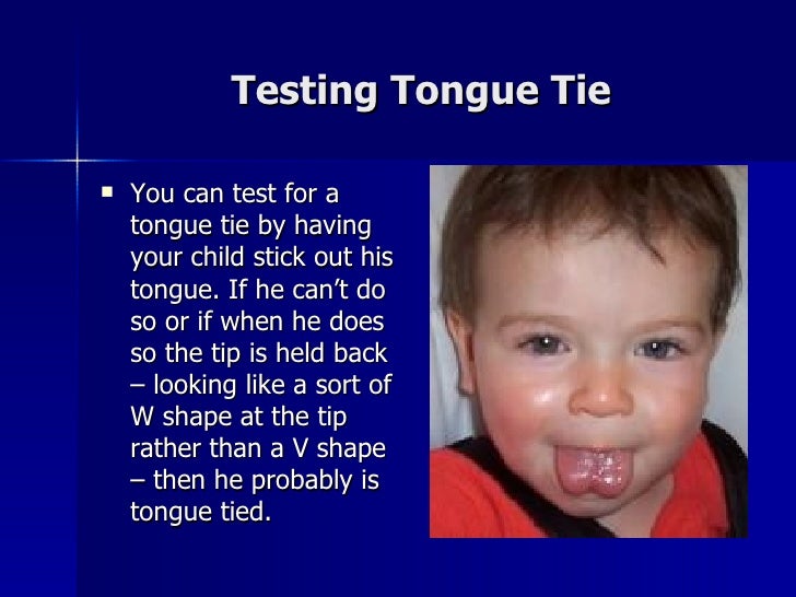Image result for tongue tie black baby