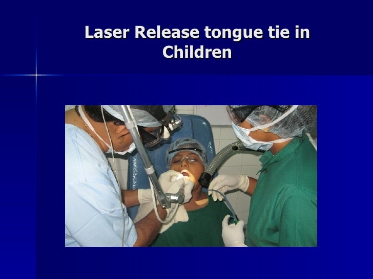 Laser Release Tongue Tie
