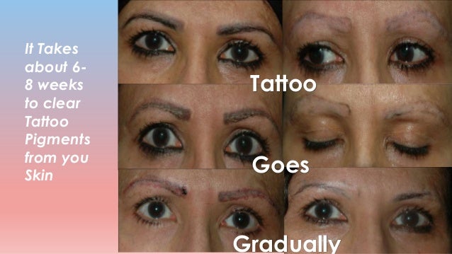 Laser tattoo removal 2015