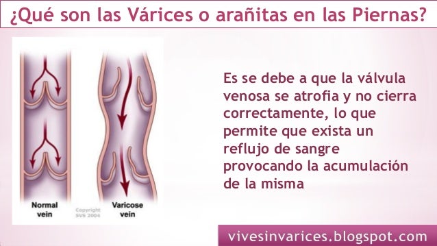 Los medios a varikoze de los pies