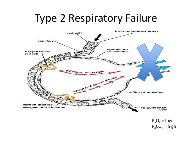 respiratory failure nursing case study respiratory failure nursing case study