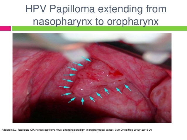 Oropharyngeal Cancer Pictures