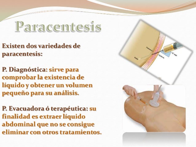 paracentesis
