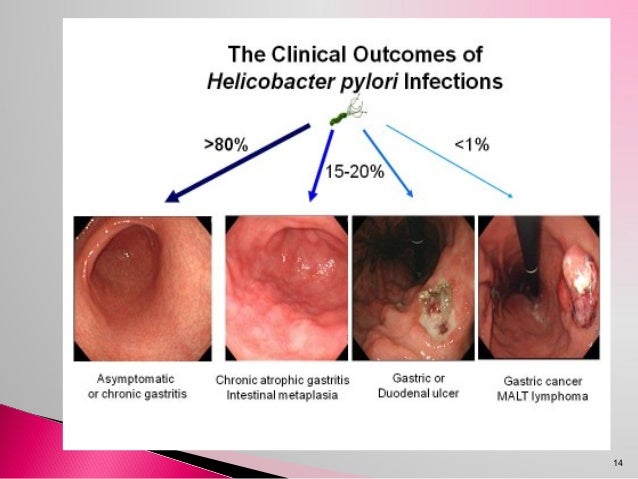 úLcera péptica e infección por helicobacter pylori