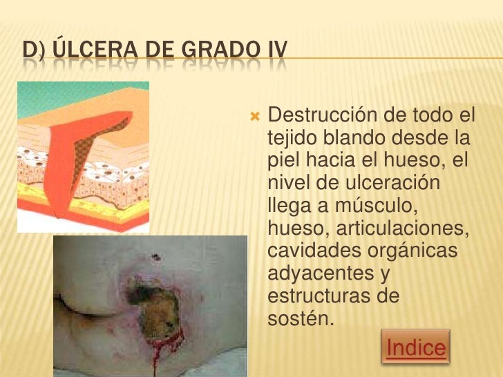 Ulceras por presión