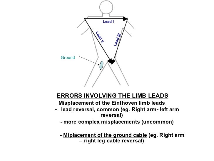Lead errors reversal of limb leads