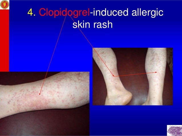 does clopidogrel cause a rash