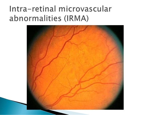 proliferative diabetic retinopathy
