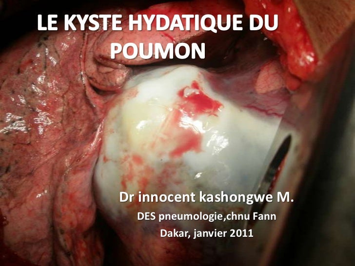 le-kyste-hydatique-du-poumon-1-728.jpg