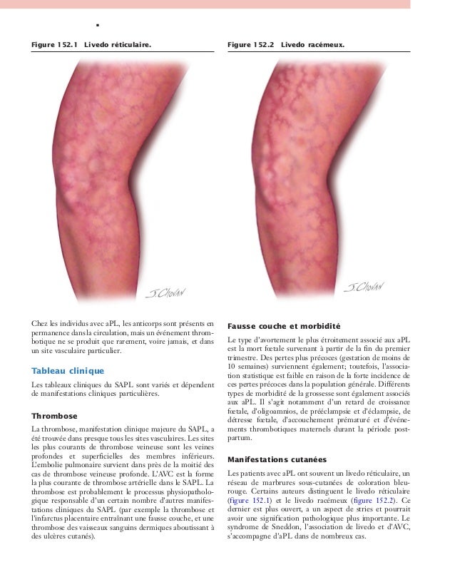 comment soigner ostéochondrite cheville
