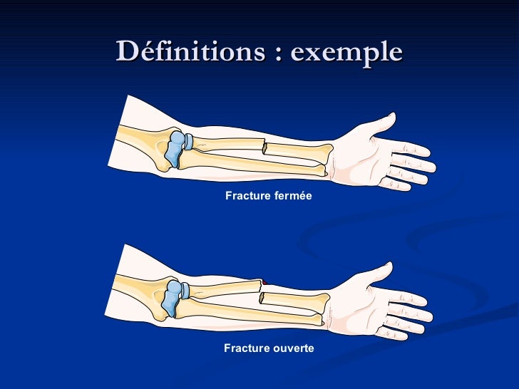 Les fractures osseuses