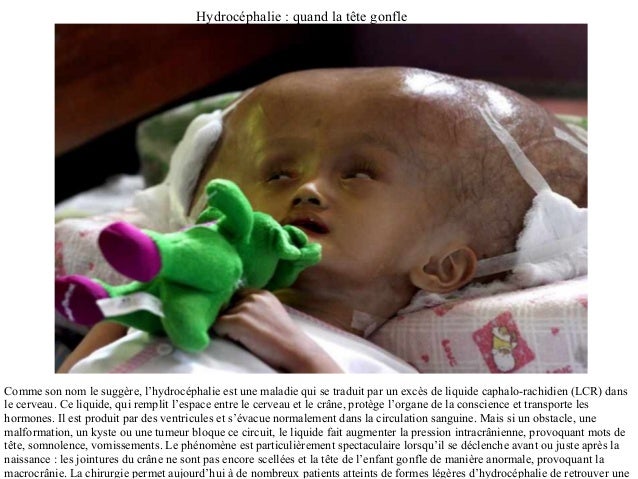 Tumeur Cerveau Deformation Crane