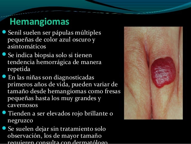 Cherry Angioma Pictures and Information