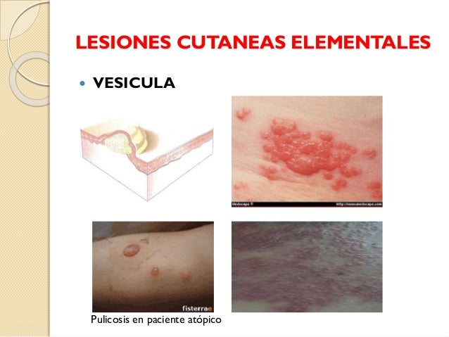 La psoriasis blanca de la foto