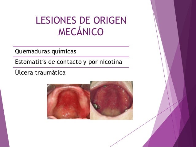 Lesiones de la mucosa oral