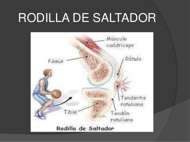 Rodilla de saltador
