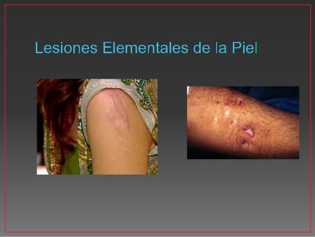Los aspectos inmunológicos de la psoriasis