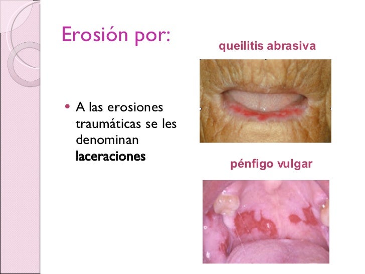 Lesiones Elementales patologia bucal