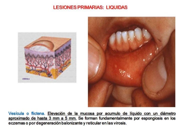 La Mucosa Oral 98