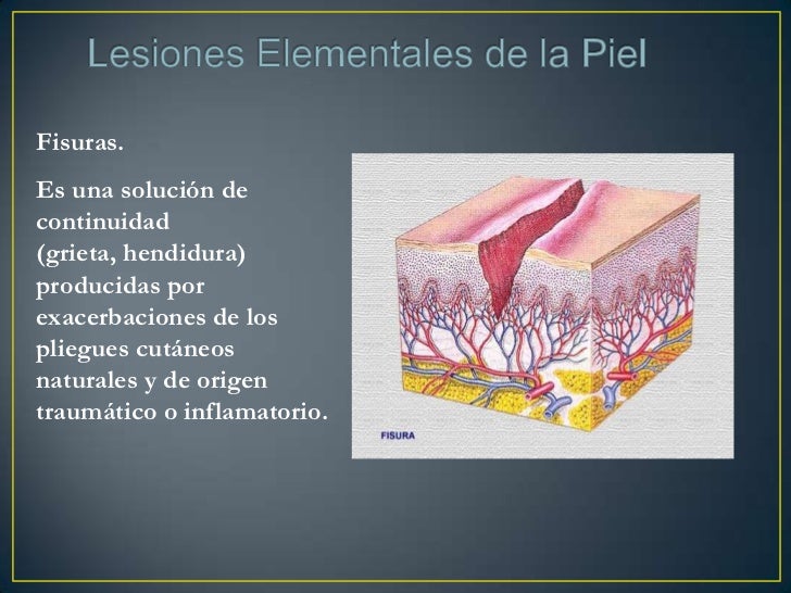 La psoriasis la eccema el cáncer de la piel