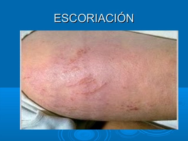 Por qué es muchas pecas en el cuerpo