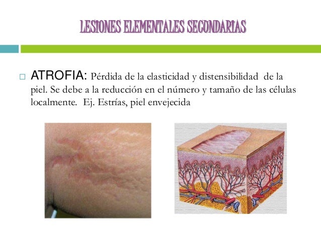 Lesiones elementales de la piel. PRIMARIAS Y SECUNDARIAS.