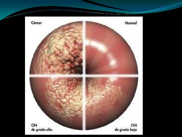 Genital / vulvovaginal candidiasis (vvc) fungal diseases cdc