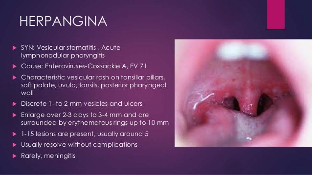 Herpangina In Adults Herpangina In Adults