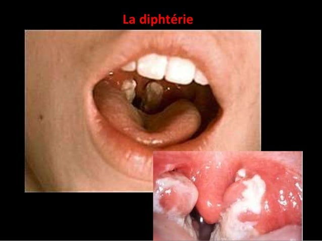 Les yeux pleurent des helminthes