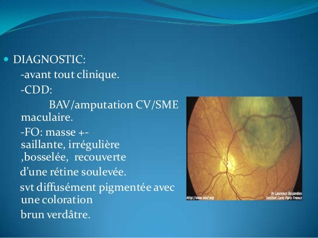 Chimiothérapie cisplatine effets secondaires curiethérapie temporaire