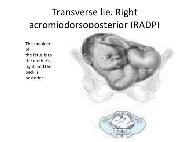 Fetal presentation Fetal presentation