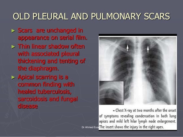 Apical Pleural Thickening Fibrosis