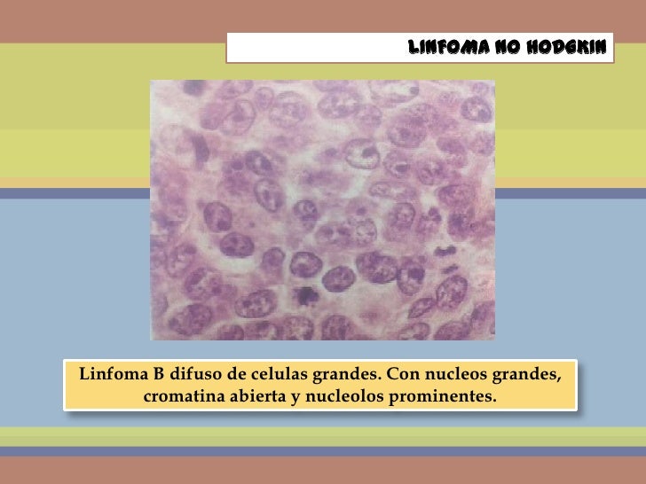 Linfoma no hodgkin