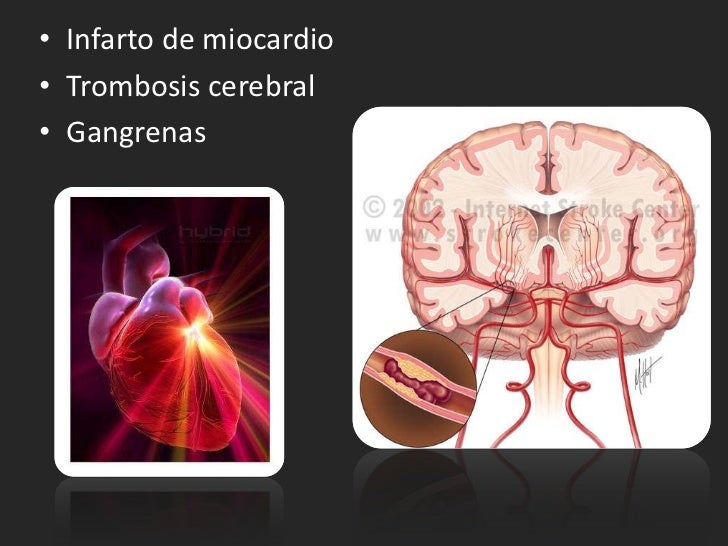 Varikoz las revocaciones sobre el tratamiento
