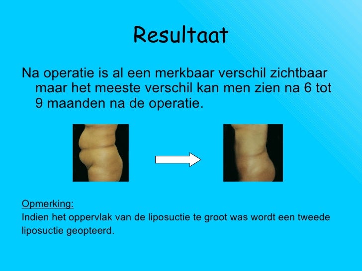 wat kost liposuctie