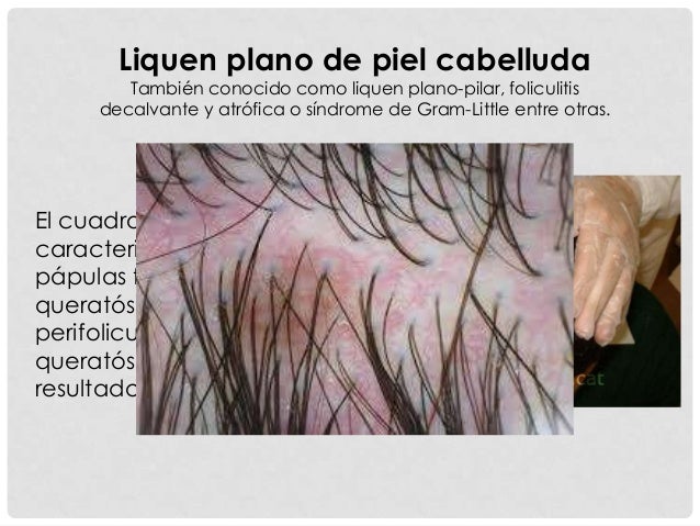 El hongo de la oreja los preparados