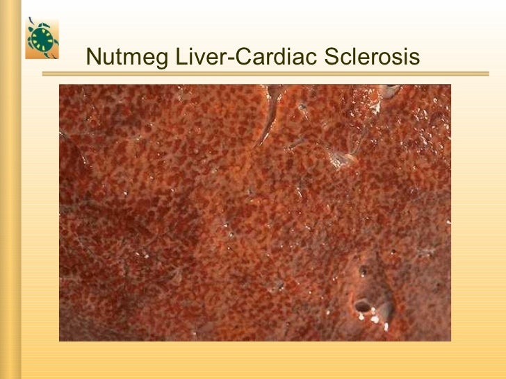 Liver Cirrhosis
