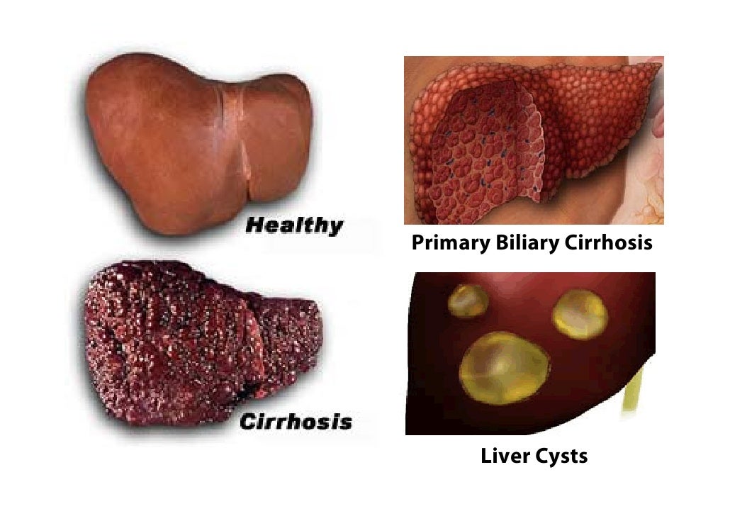 Cialis Liver Disease