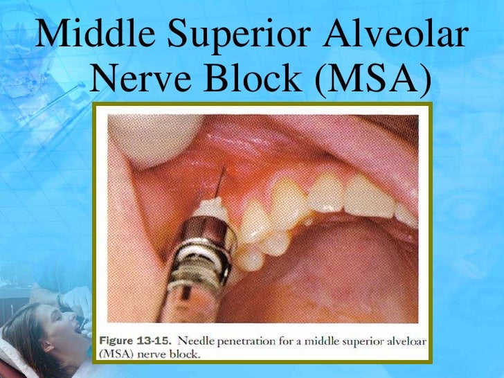 Local anaesthesia and techniques for pedodontics